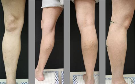 лечение на разширени вени на левия крак